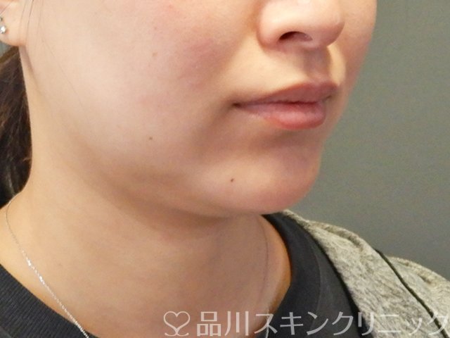症例NO.65569のBEFORE写真