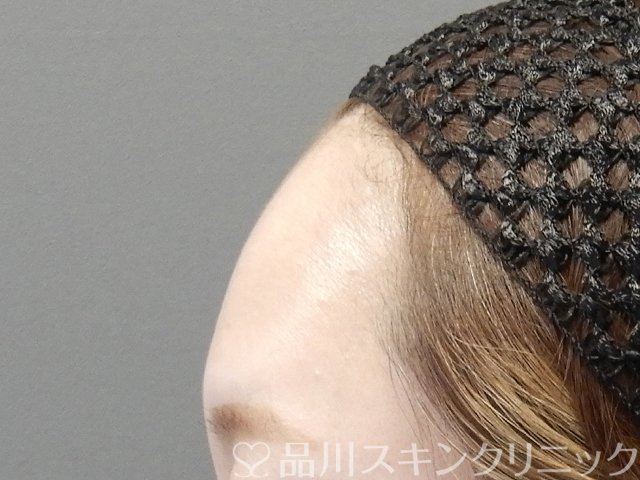 症例NO.64983のBEFORE写真