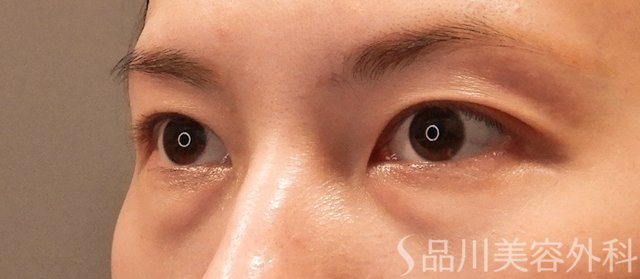 症例NO.72268のBEFORE写真