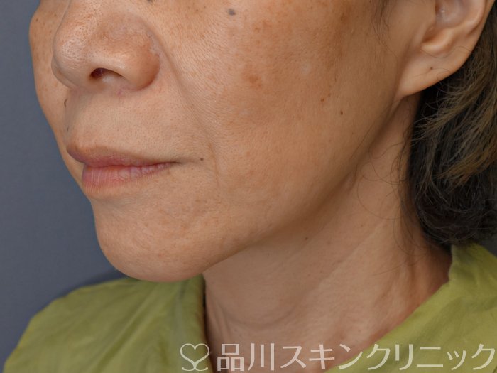 症例NO.71260のBEFORE写真