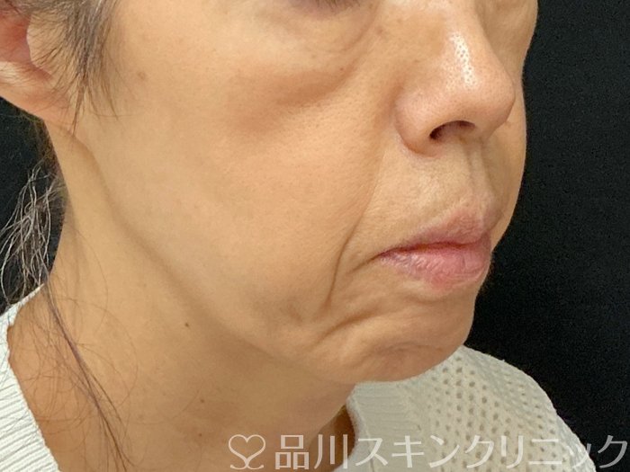 症例NO.74000のBEFORE写真
