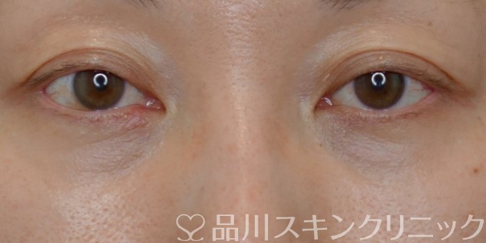 症例NO.72666のBEFORE写真