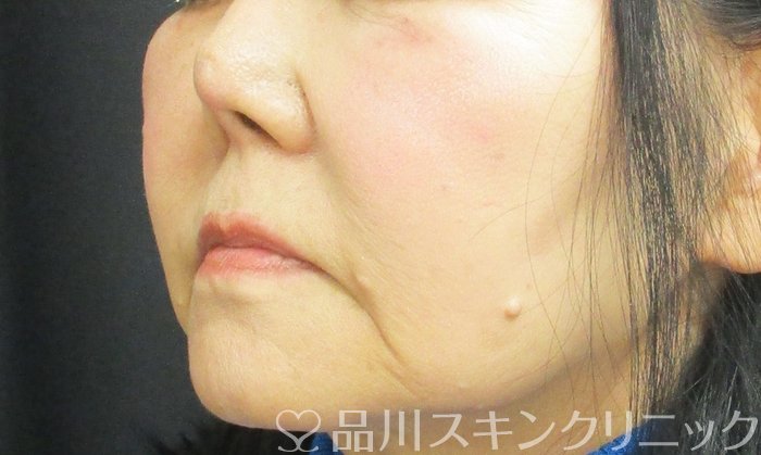 症例NO.72745のBEFORE写真