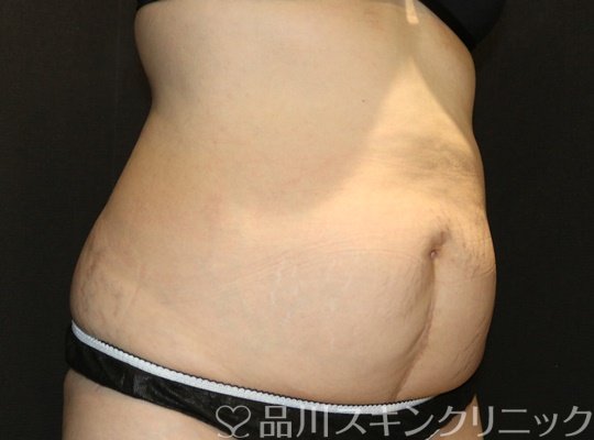 症例NO.72950のAFTER写真