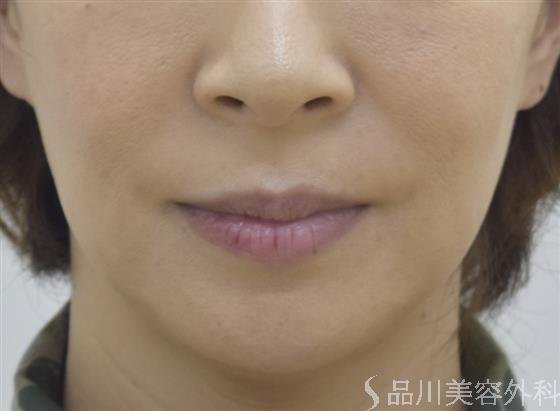 症例NO.45253のBEFORE写真