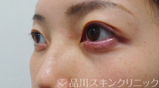 症例NO.70672のAFTER写真