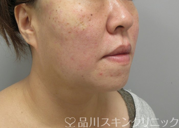 症例NO.71463のAFTER写真