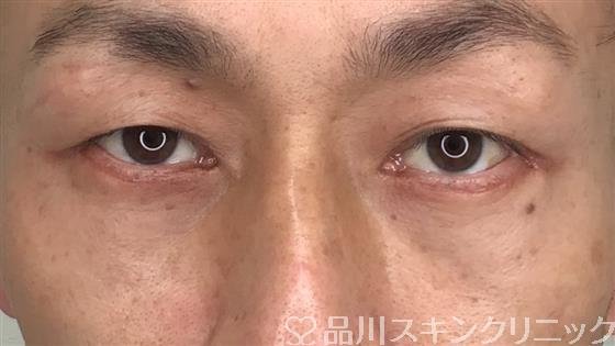 症例NO.57336のAFTER写真