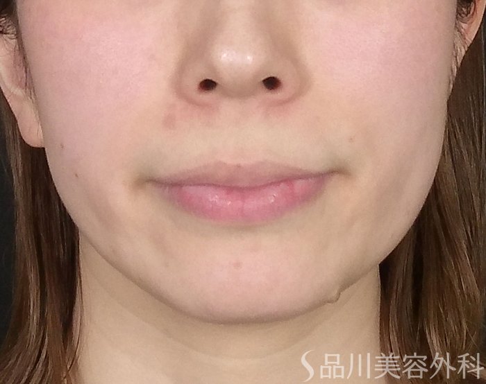 症例NO.65520のBEFORE写真