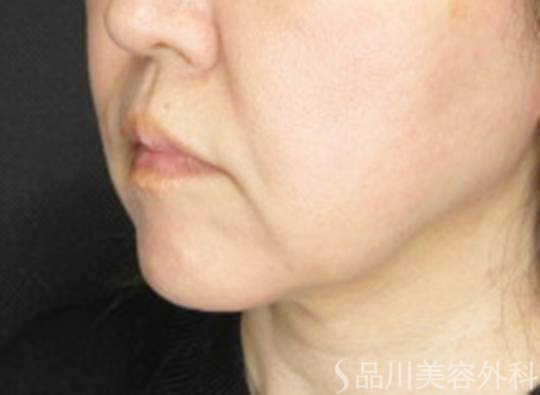 症例NO.74846のBEFORE写真