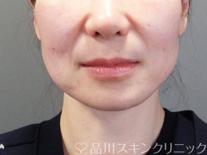 症例NO.74103のAFTER写真