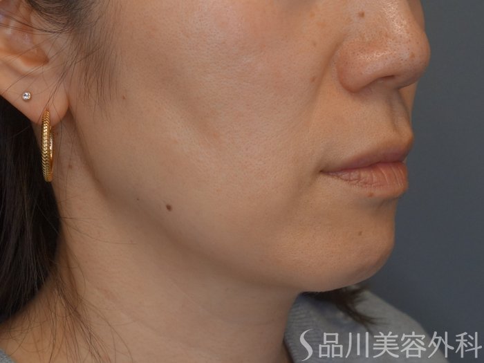 症例NO.74988のBEFORE写真