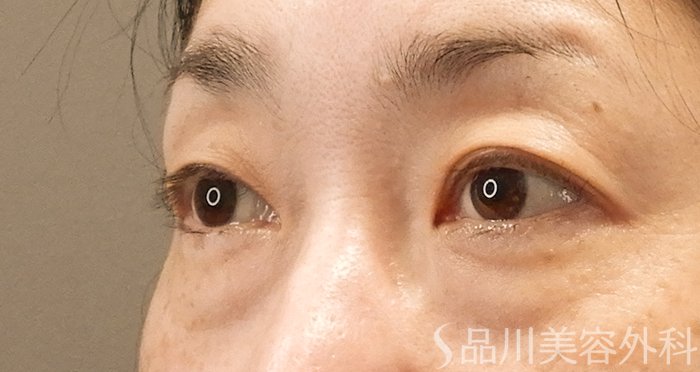 症例NO.70973のBEFORE写真