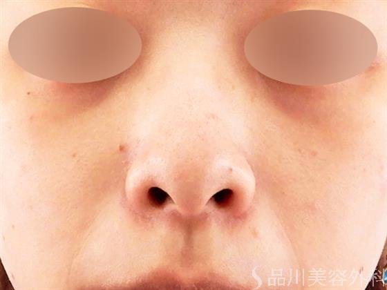 症例NO.60673のBEFORE写真