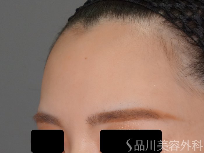 症例NO.71126のBEFORE写真