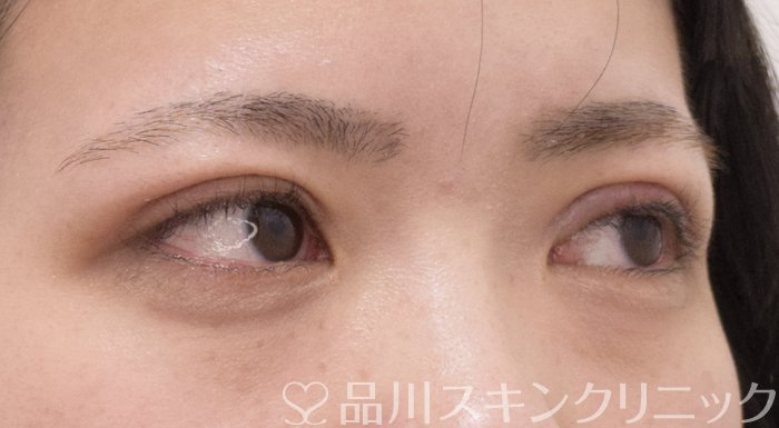 症例NO.71183のAFTER写真