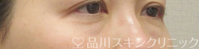 症例NO.71660のBEFORE写真