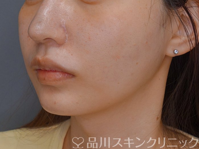 症例NO.73786のAFTER写真