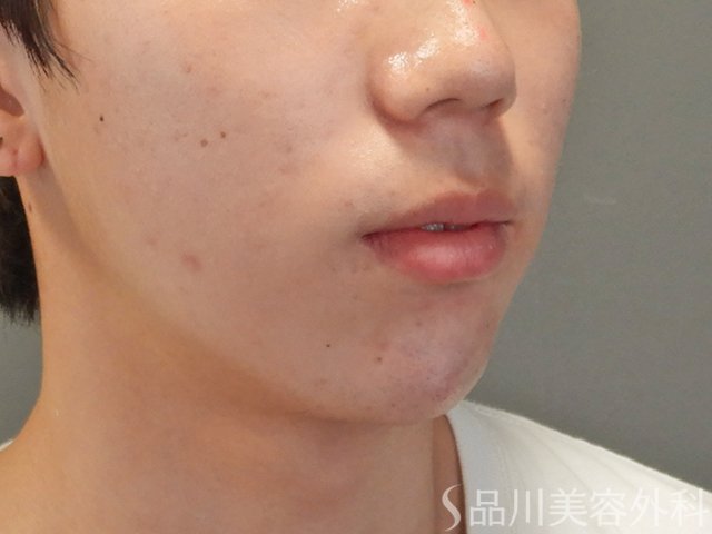 症例NO.74901のAFTER写真