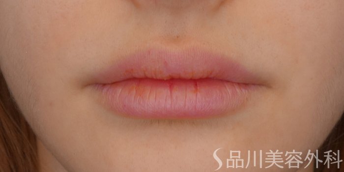 症例NO.72422のBEFORE写真