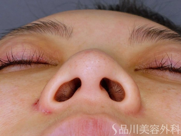 症例NO.73608のBEFORE写真