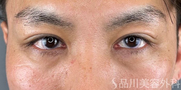 症例NO.70737のAFTER写真