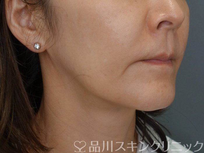 症例NO.71752のBEFORE写真