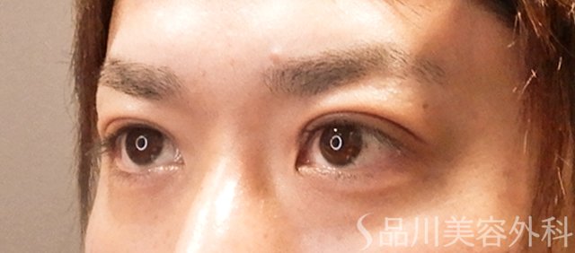 症例NO.70985のAFTER写真