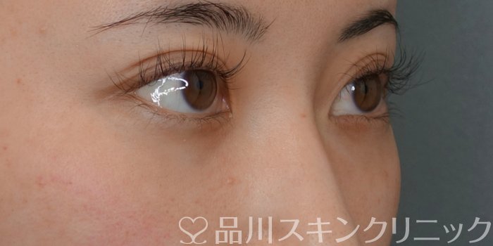 症例NO.74048のBEFORE写真