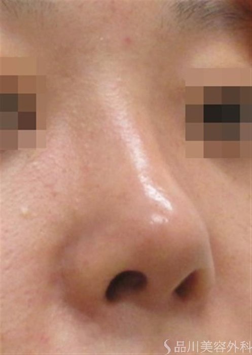 症例NO.23856のAFTER写真