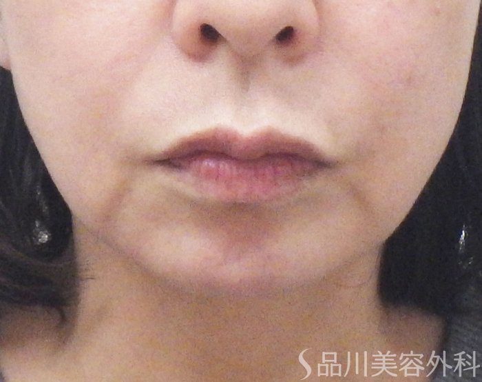 症例NO.72818のBEFORE写真