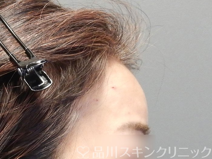 症例NO.72652のAFTER写真