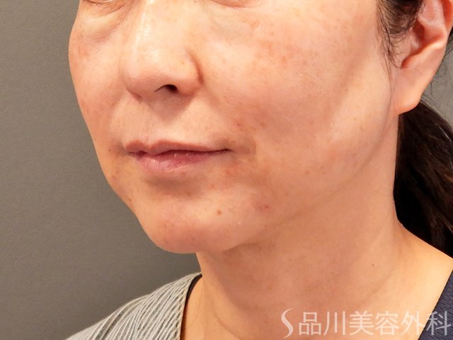 症例NO.70433のAFTER写真
