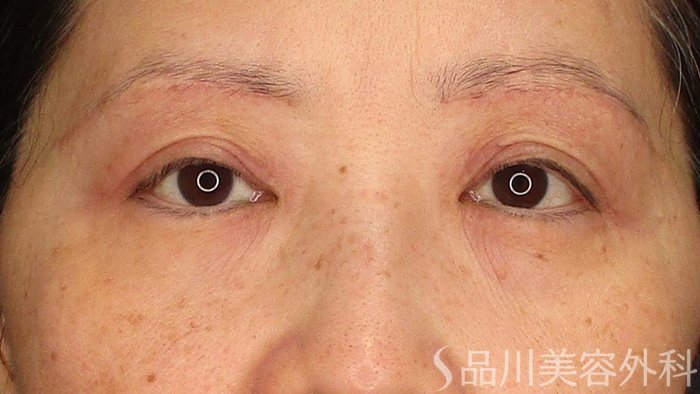 症例NO.71807のAFTER写真