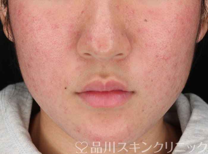 症例NO.62365のBEFORE写真