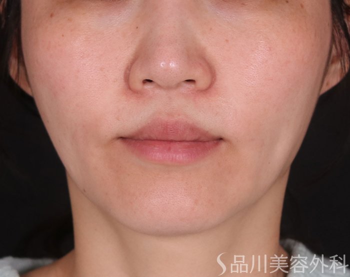 症例NO.73116のBEFORE写真