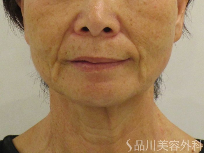 症例NO.74724のBEFORE写真