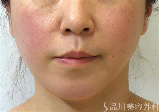 症例NO.35169のAFTER写真