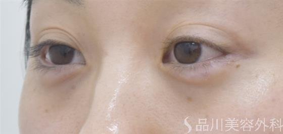 症例NO.43838のAFTER写真