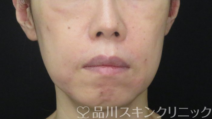 症例NO.72502のAFTER写真