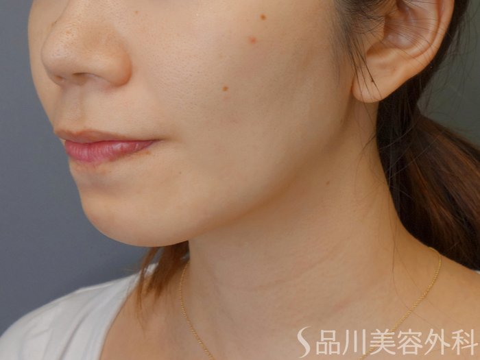 症例NO.71837のBEFORE写真
