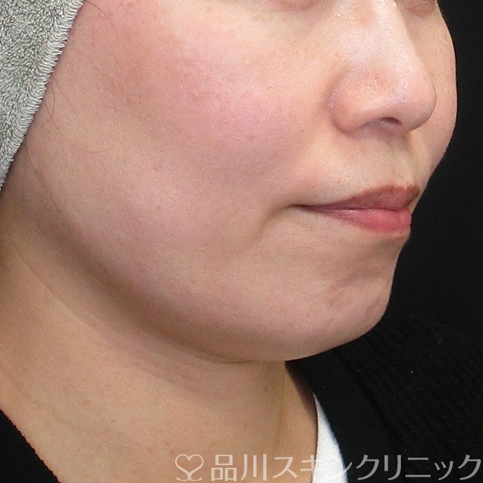 症例NO.73475のBEFORE写真