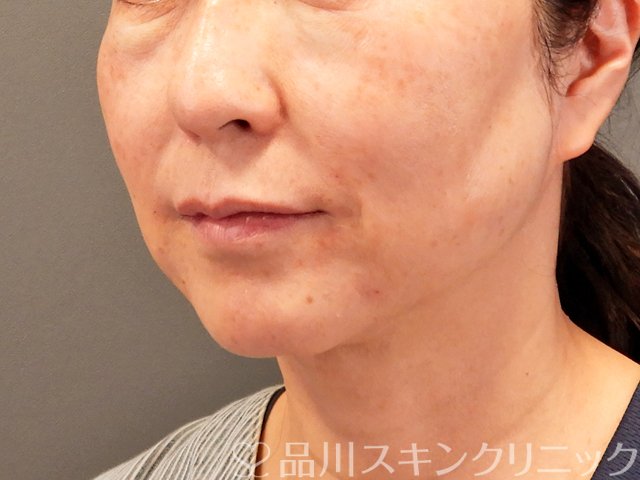 症例NO.70433のAFTER写真