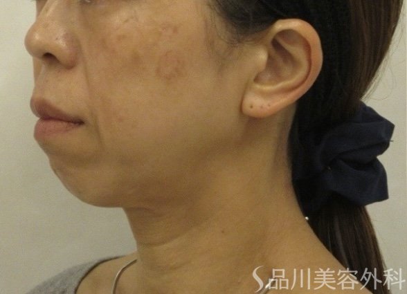 症例NO.74858のBEFORE写真