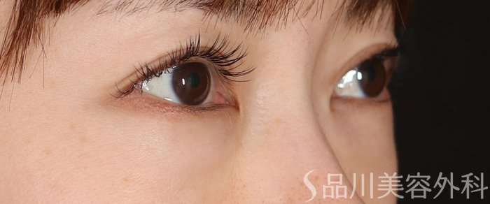 症例NO.72172のBEFORE写真