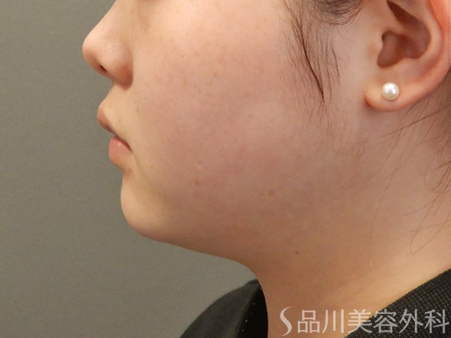 症例NO.75230のBEFORE写真