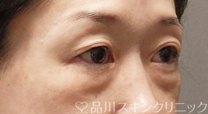 症例NO.69557のBEFORE写真