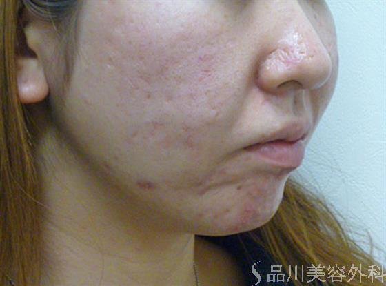 症例NO.22765のBEFORE写真