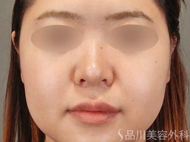 症例NO.75316のAFTER写真