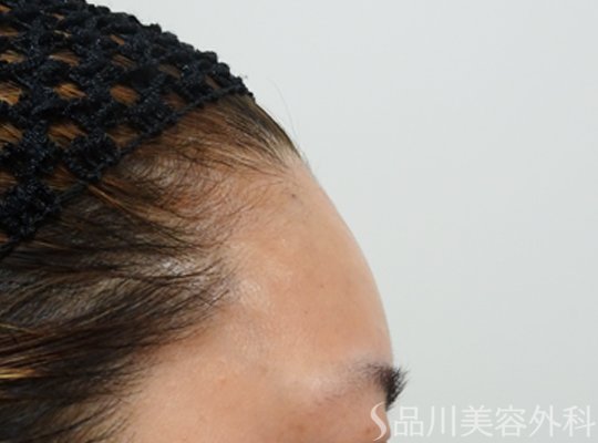 症例NO.72380のAFTER写真